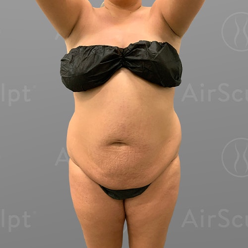 before stomach airsculpt