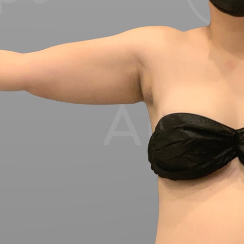 Before armpit liposuction