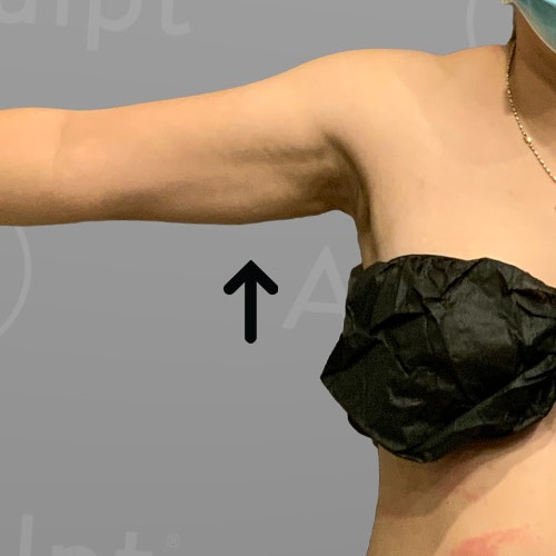 after arm airsculpt