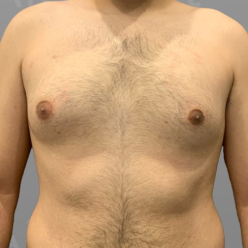 before male chest airsculpt
