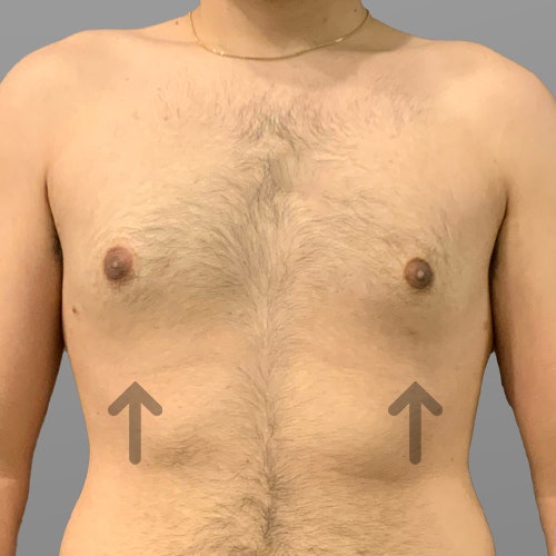 after male chest airsculpt