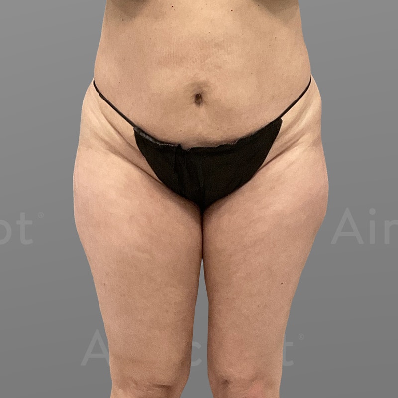 before inner and outer thigh airsculpt