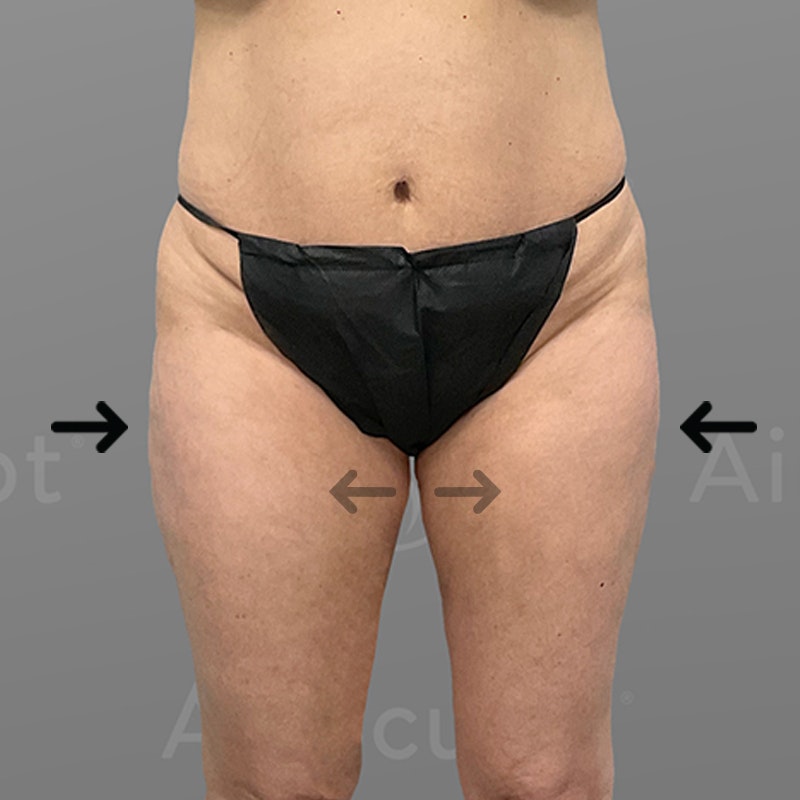 after inner and outer thigh airsculpt