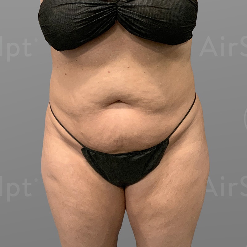 before stomach, pubic, and back bra roll airsculpt