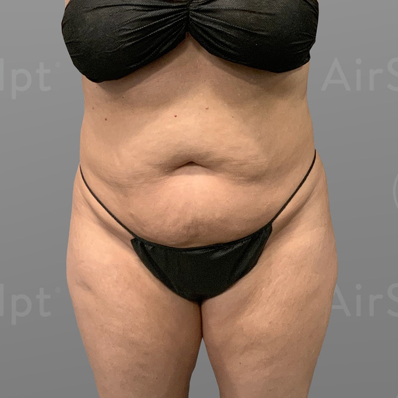 Austin Mons Pubis Liposuction  AirSculpt® Pubic Fat Removal