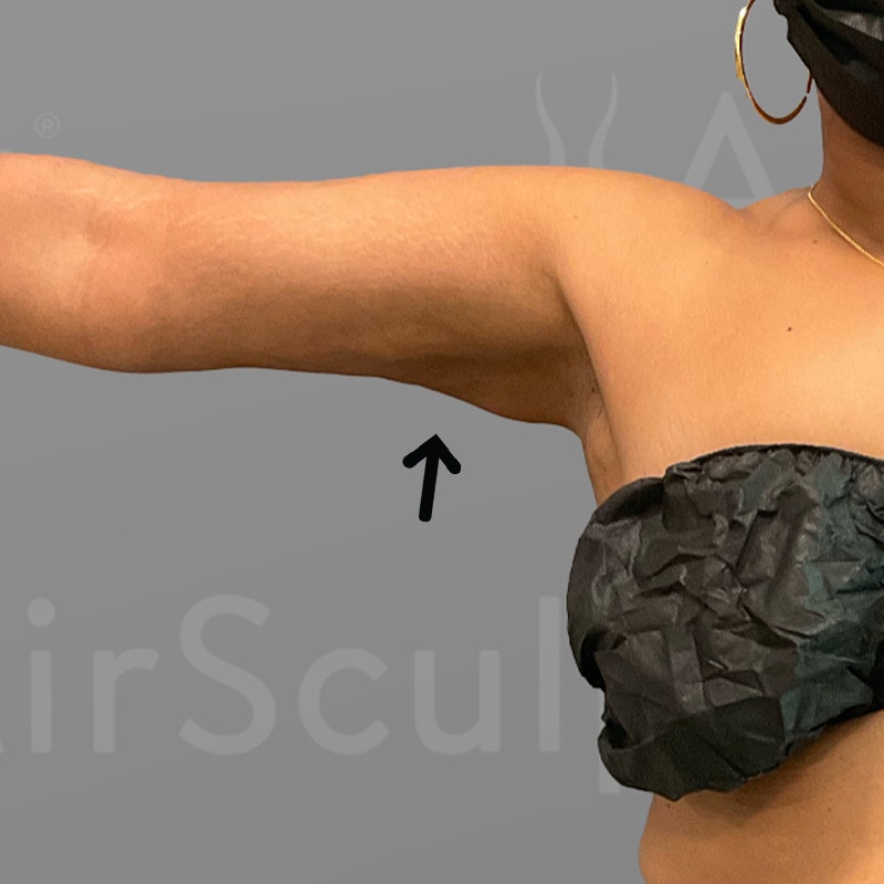 after arm airsculpt