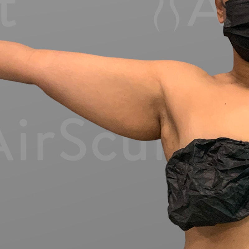 before arm airsculpt