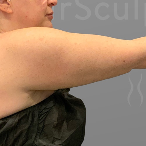 before arm airsculpt