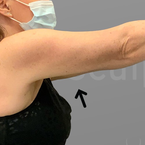 after arm airsculpt
