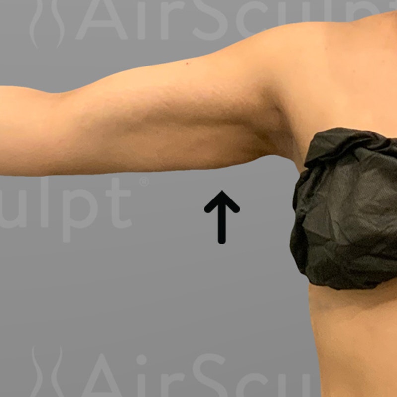 after arm airsculpt