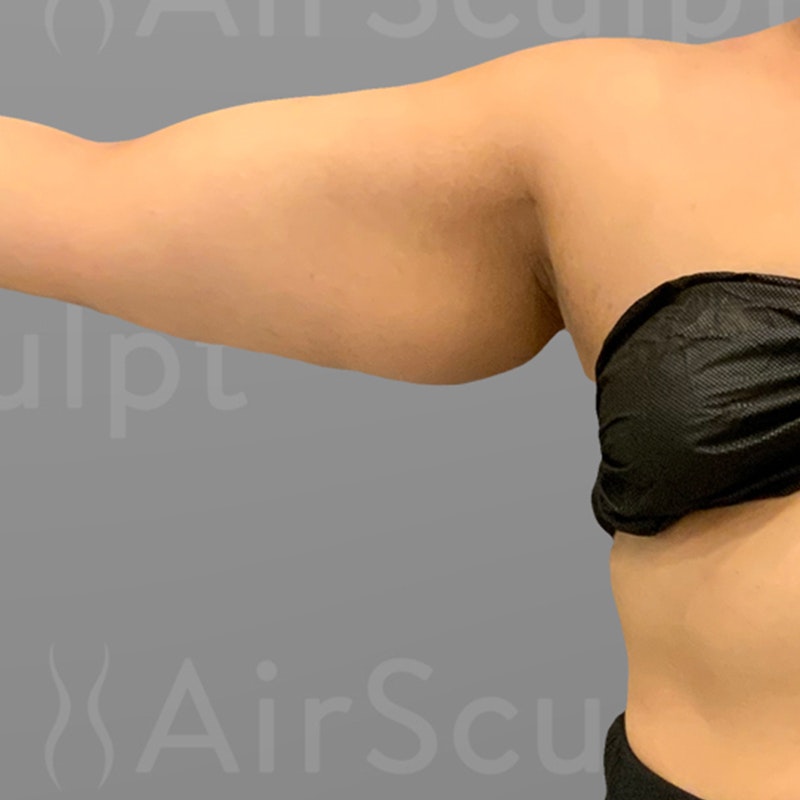 before arm airsculpt
