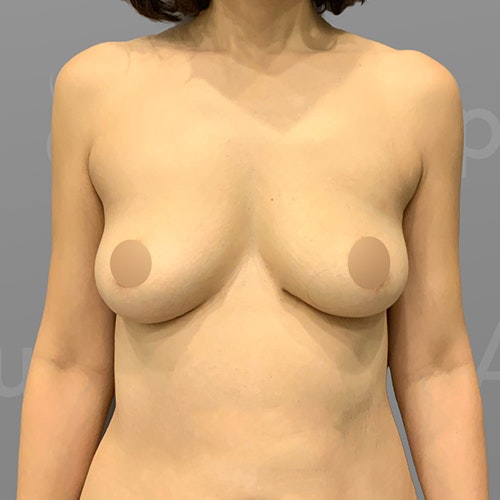 before up a cup airsculpt