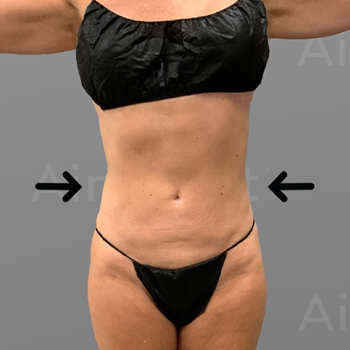 after Stomach AirSculpt+ LeeAnne Locken