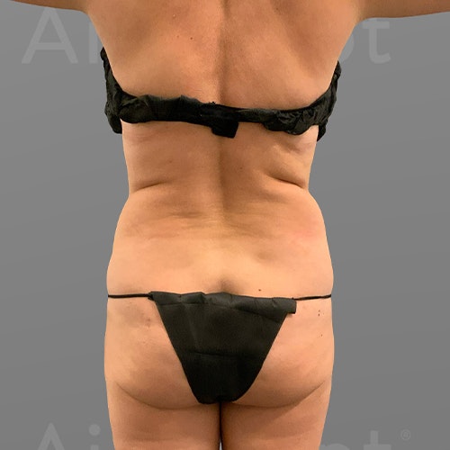 before Stomach AirSculpt+ LeeAnne Locken