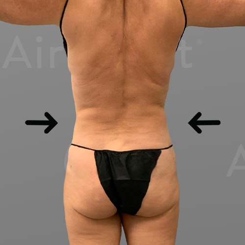 after Stomach AirSculpt+ LeeAnne Locken
