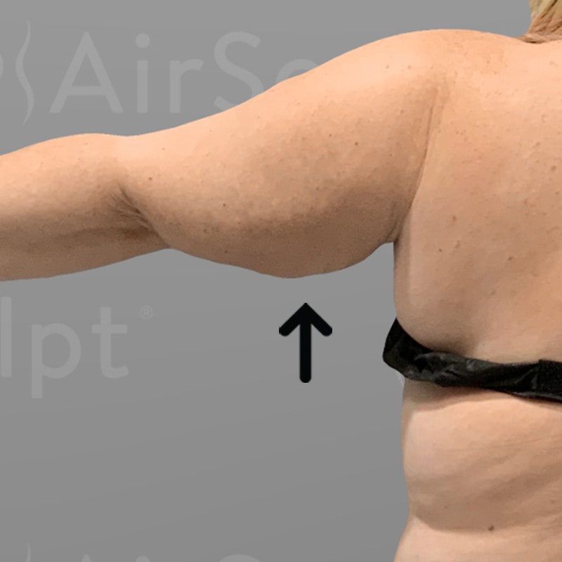 after arm fat removal