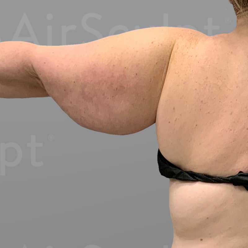before arm fat removal