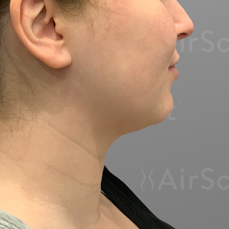 before chin liposuction