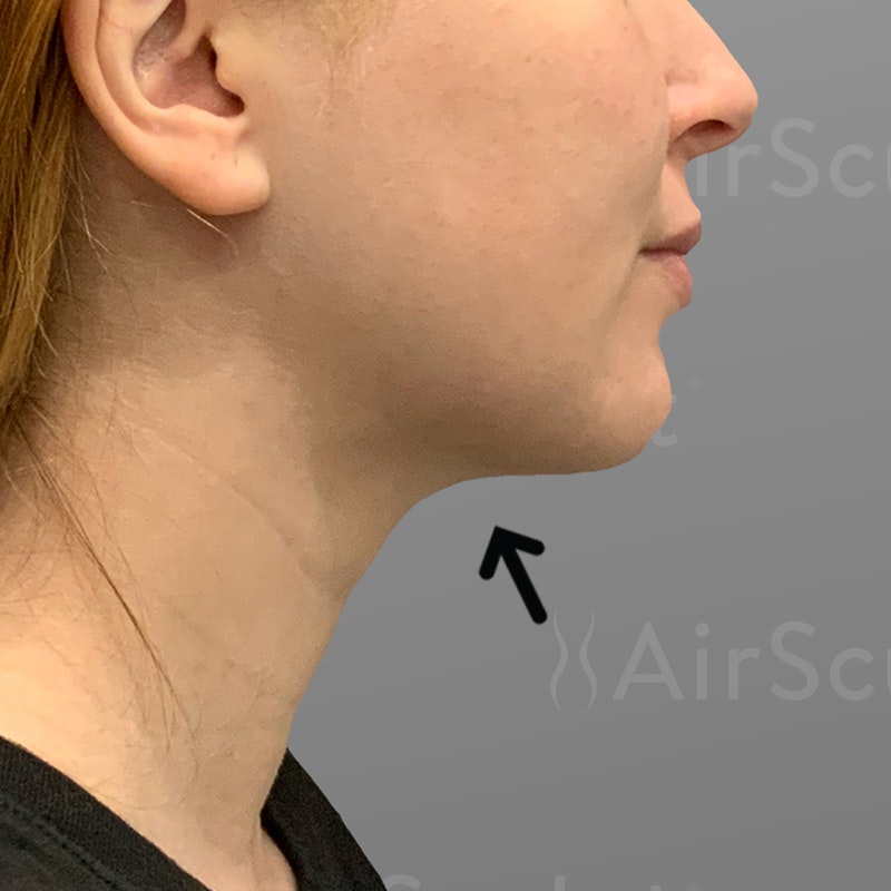 after chin liposuction