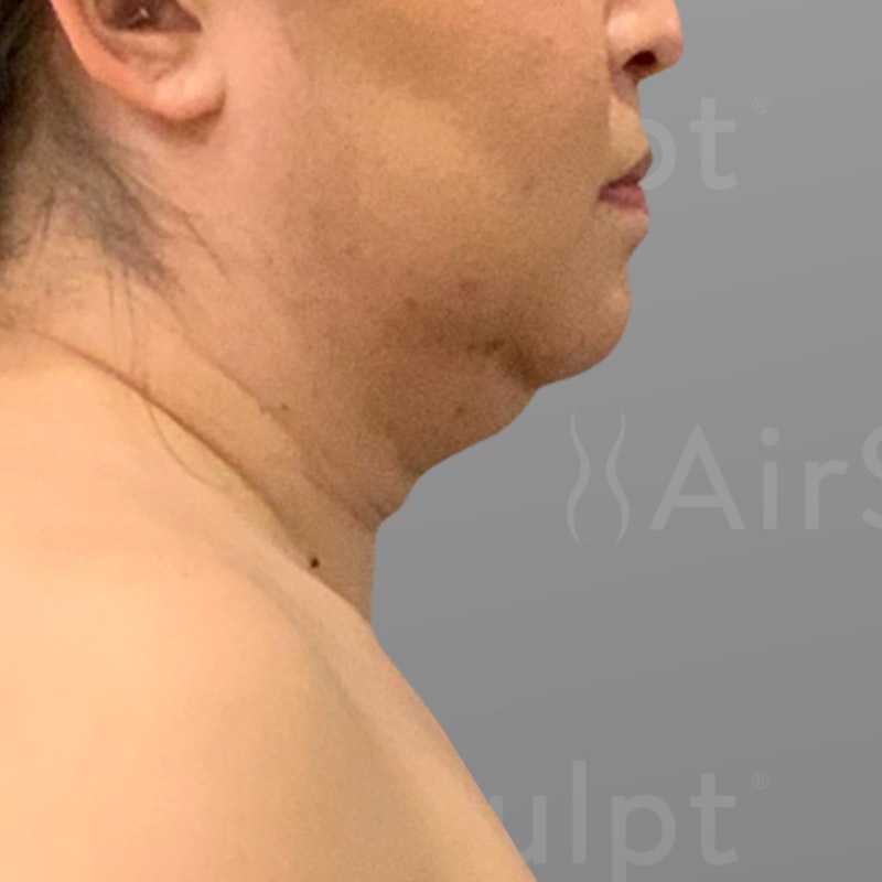 before chin airsculpt plus