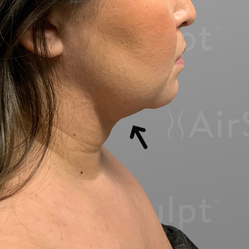 after chin airsculpt plus