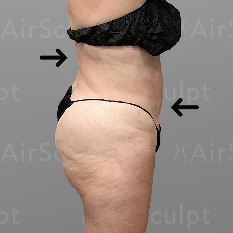 after stomach airsculpt+