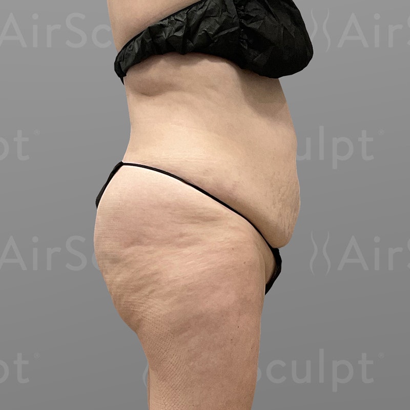 before stomach airsculpt +