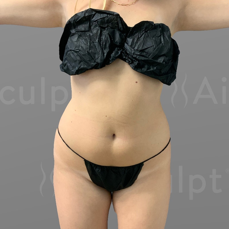 Audrey stomach before airsculpt