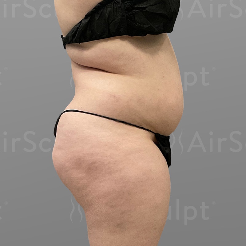 before stomach airsculpt plus