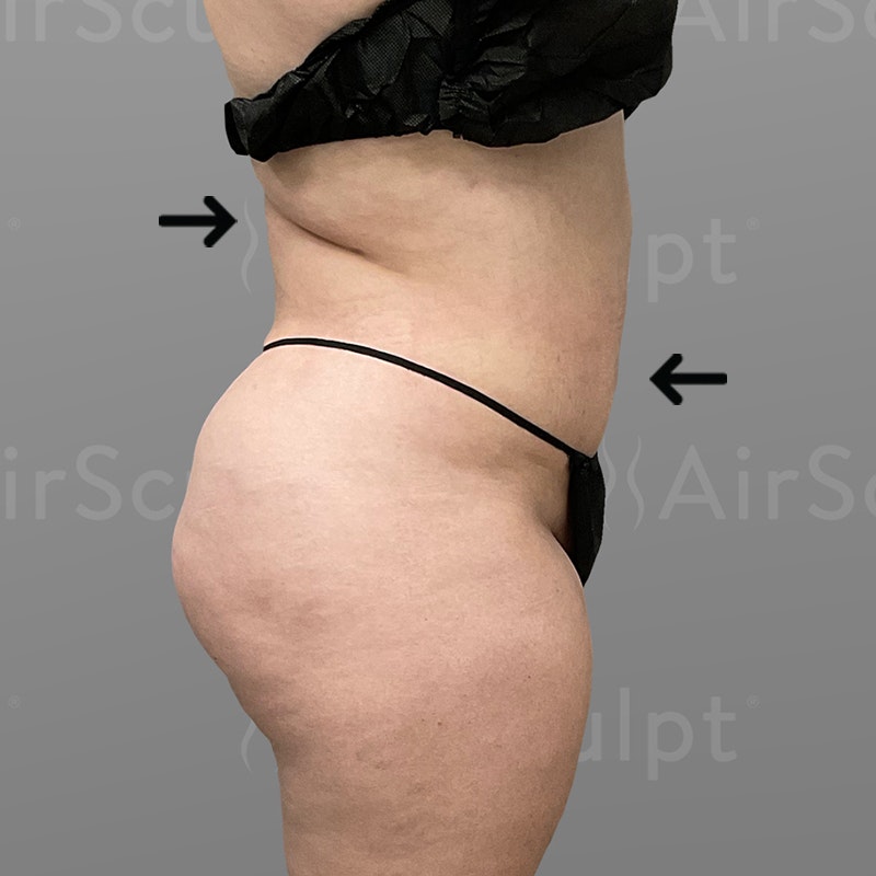 after stomach airsculpt plus