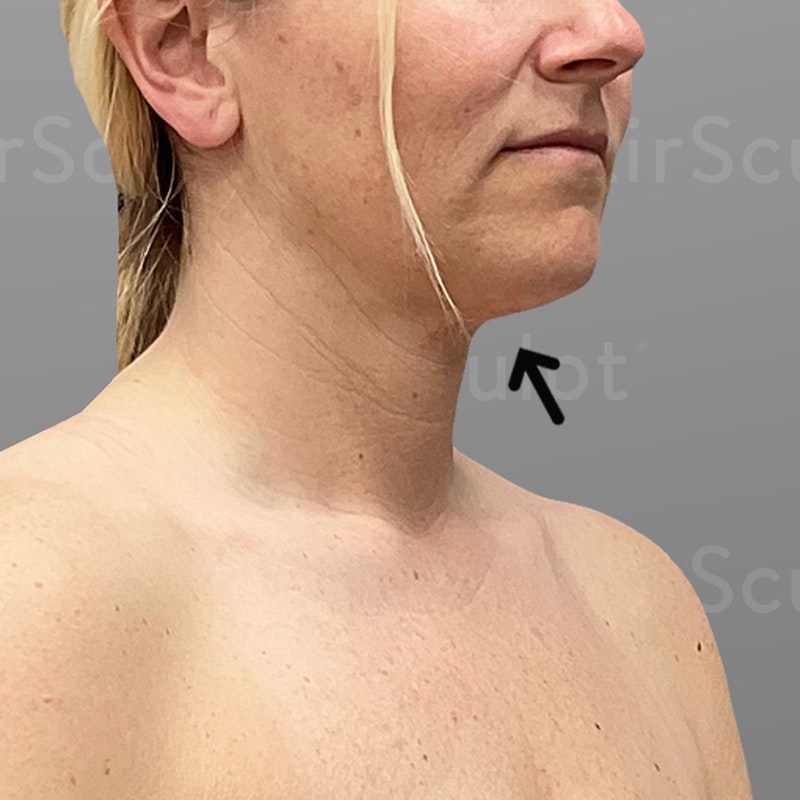 after chin airsculpt