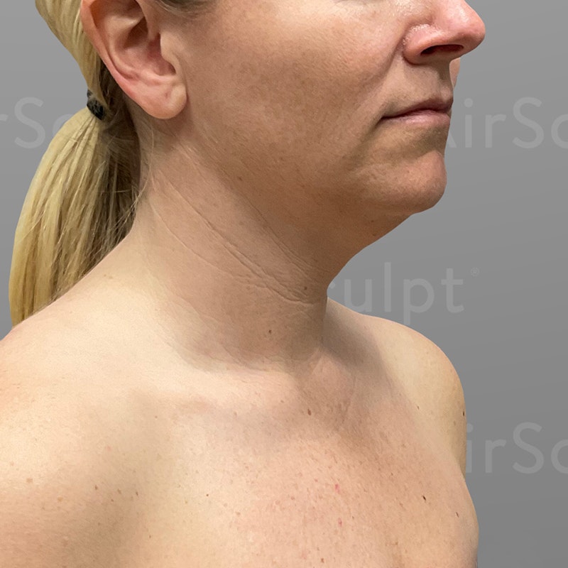 before chin airsculpt