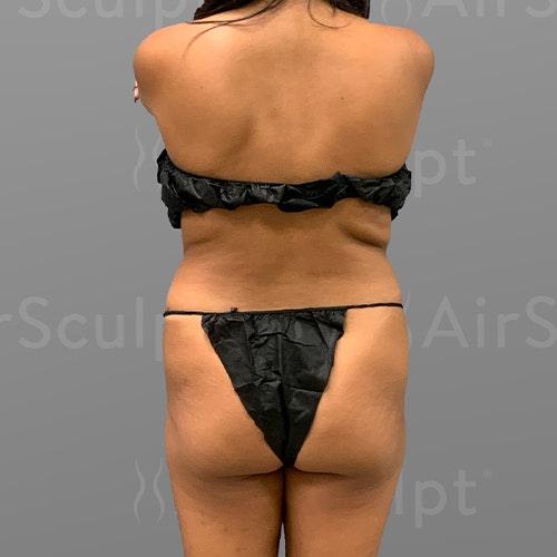 before full abdominal airsculpt + HipFlip