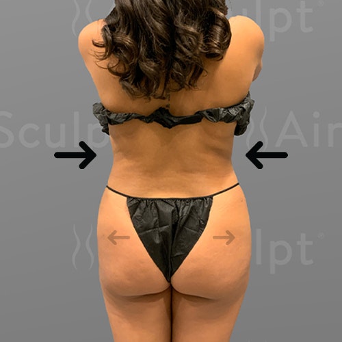 after full abdominal airsculpt + HipFlip