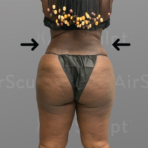 Flanks liposuction NYC - Best Flanks liposuction in NYC