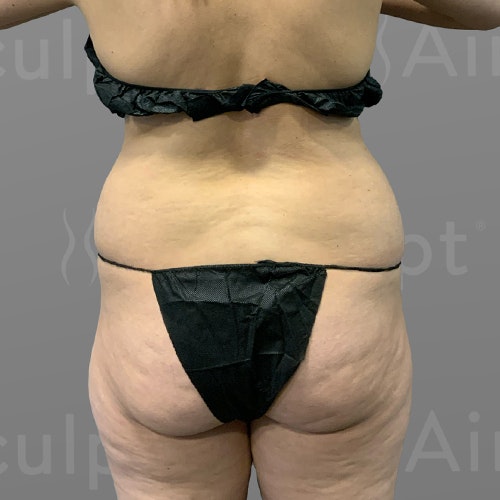 before stomach, back bra roll, Power BBL AirSculpt
