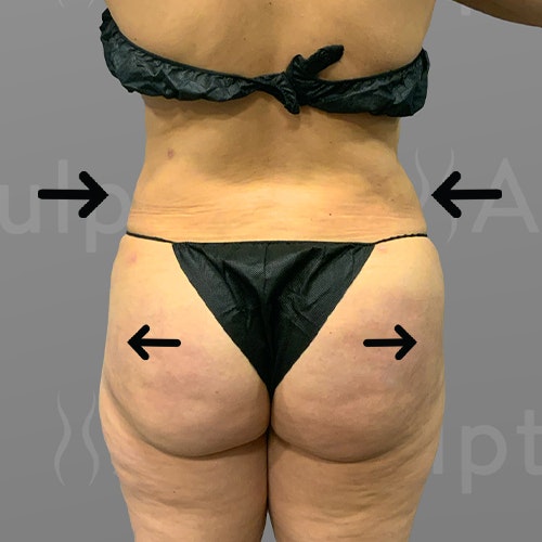 after stomach, back bra roll, Power BBL AirSculpt