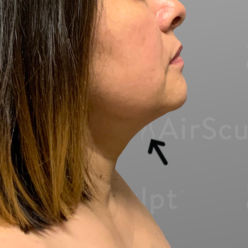 after chin liposuction
