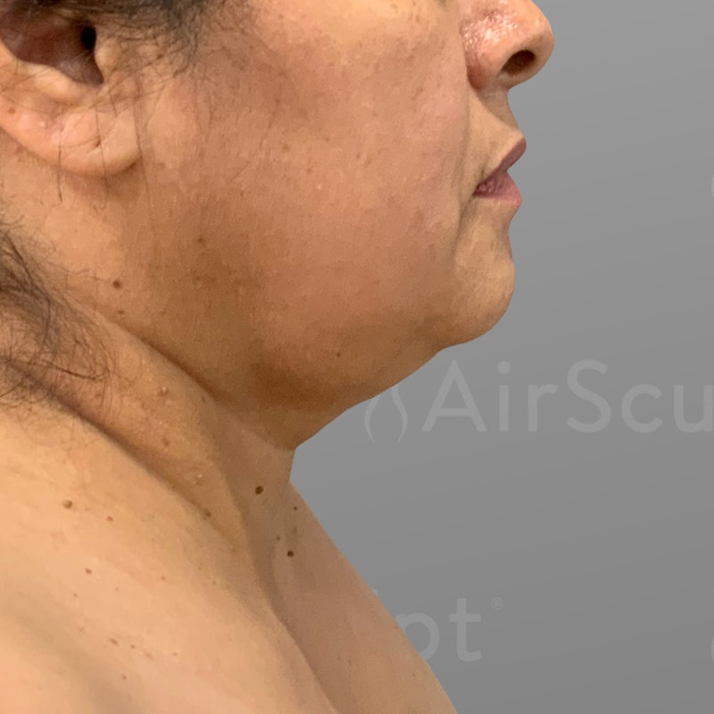 before chin liposuction