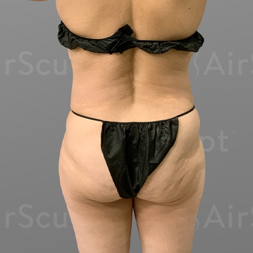 before Stomach and BBL AirSculpt