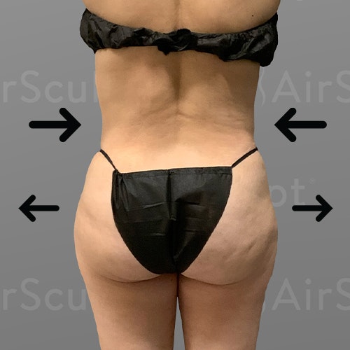 after stomach and BBL AirSculpt