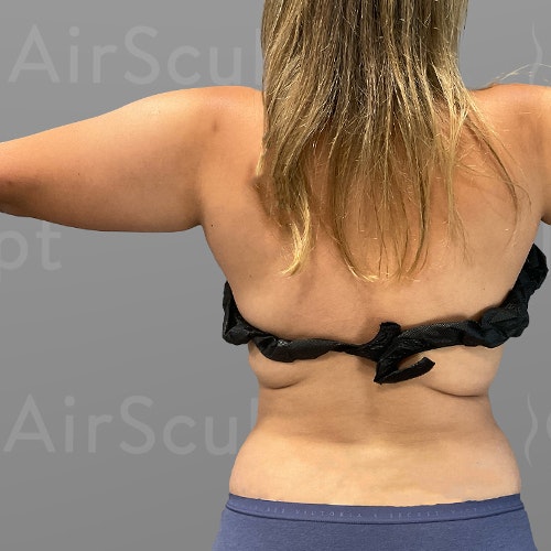 before arm and back bra roll lipo