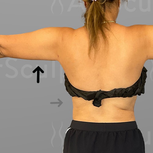 after arm and back bra roll lipo