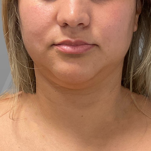 before chin airsculpt