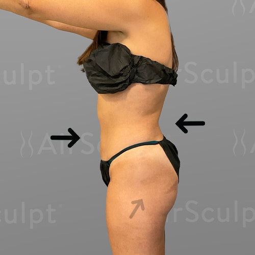after stomach and BBL AirSculpt
