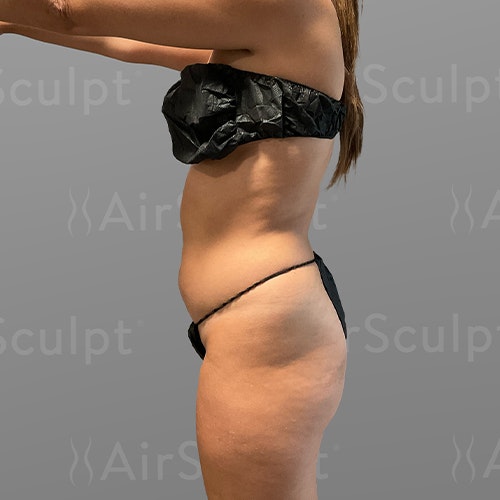 before Stomach and BBL AirSculpt
