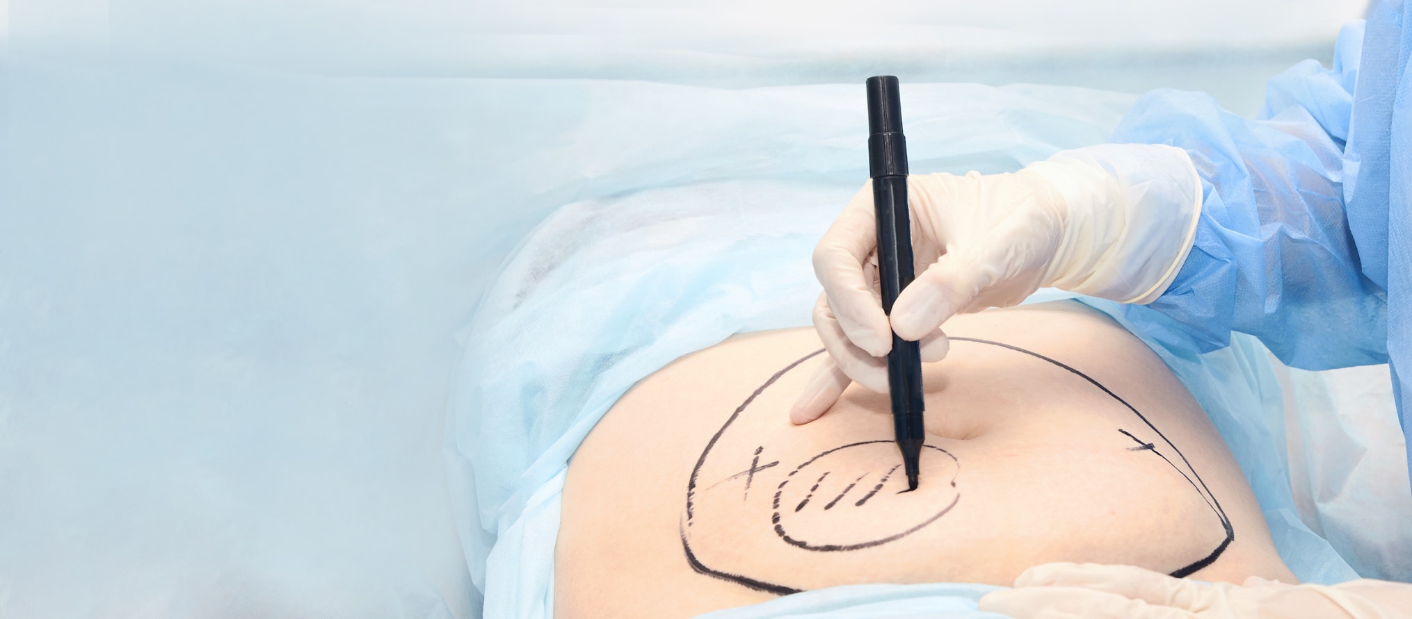 surgeon tracing incision area