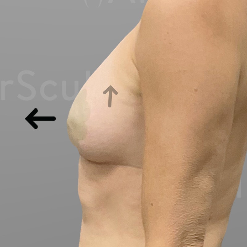 after airsculpt breast augmentation