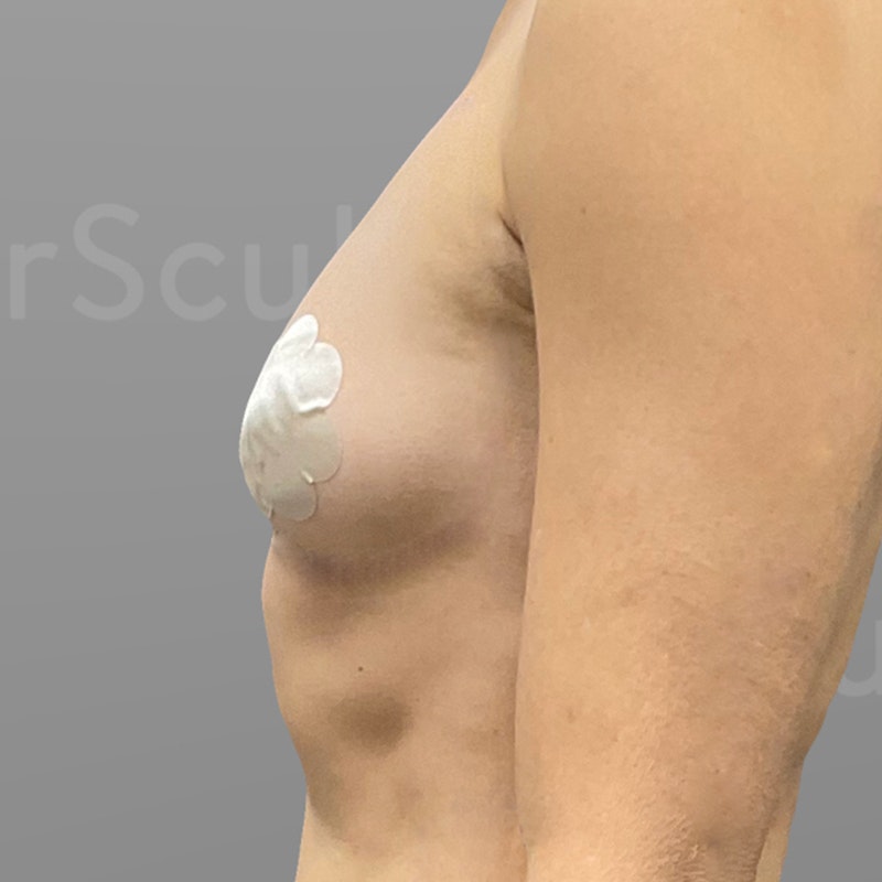 before airsculpt breast augmentation