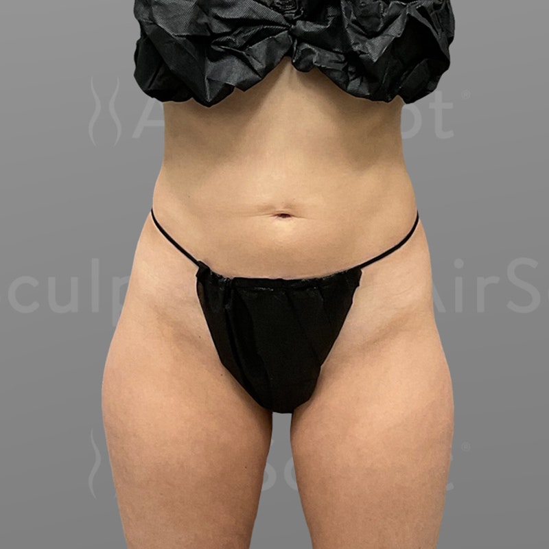 before stomach airsculpt +